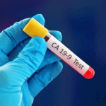 CA-19.9 Pancreatic Cancer Marker