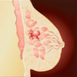CA-15.3 Breast Cancer marker