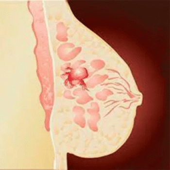 CA-15.3 Breast Cancer marker