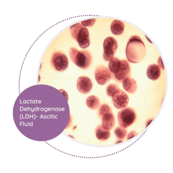 Fluid LDH (Lactate Dehydrogenase)