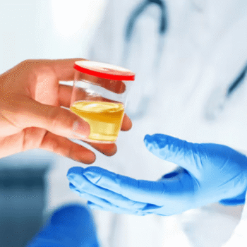 Urine Microalbumin
