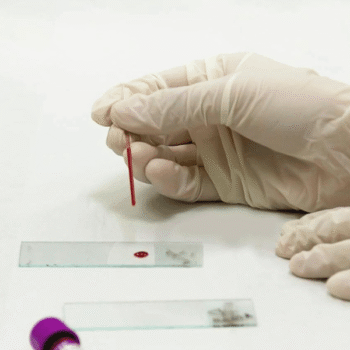 Peripheral Blood Film(PBF)