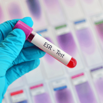Erythrocyte Sedimentation Rate(ESR)