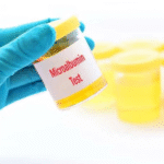 Urine Microalbumin Test