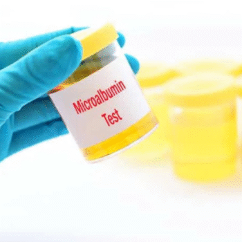 Urine Microalbumin Test