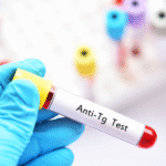 Anti-Tg (Anti-Thyroglobulin Antibody)